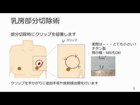 乳房切除術について詳しく解説