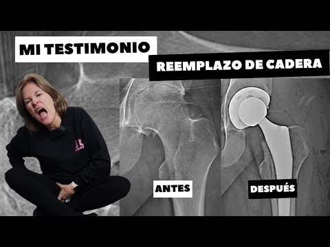 Reemplazo de cadera