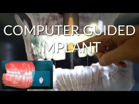 Computer Guided Dental Implant - Crisis Averted
