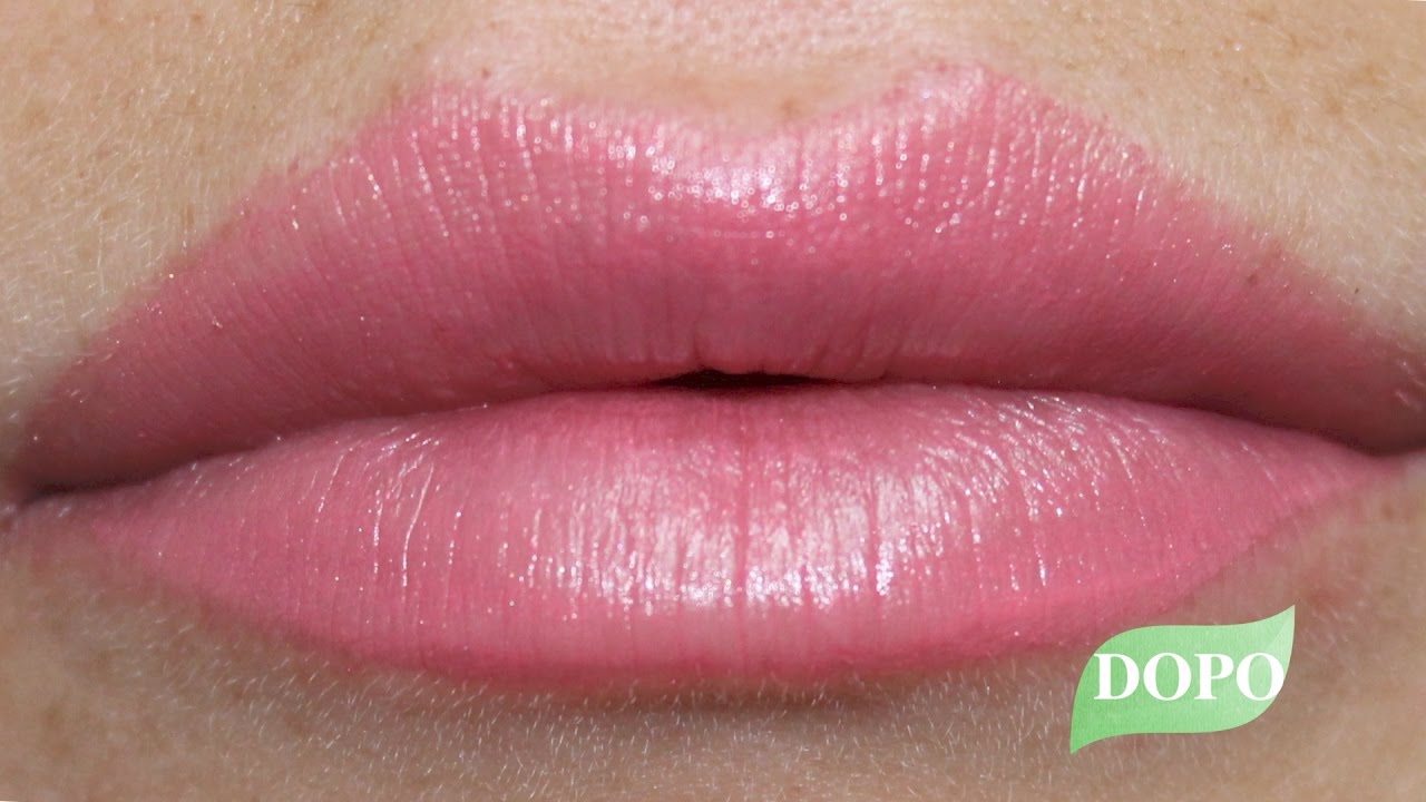 Watch Now Filler Labbra - Prima e Dopo Filler Labbra - Prima e Dopo