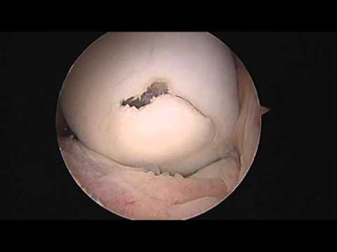 Csípőízület akut ízületi gyulladásának kezelése
