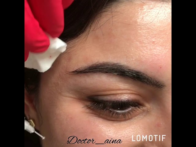 Коррекция морщин ботоксом