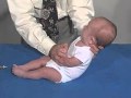 Neurology Exam, 3 Month: Primitive Reflexes-Moro