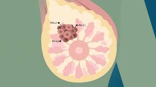 New advancements in triple-negative breast cancer (TNBC) | ATRACTIB Phase 2 Trial
