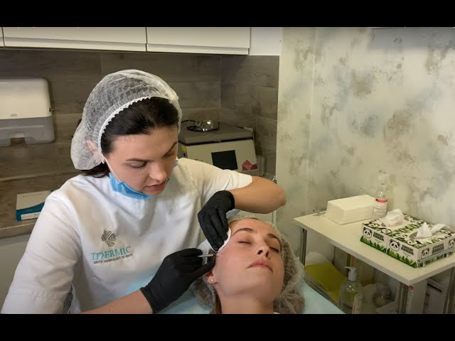 Коригування Шрамів Кістозного Акне за допомогою Radiesse – Косметологічний центр IDERMIC у Львові