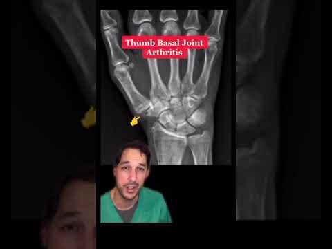 Basilar Thumb Arthritis in a 67 year old Female presented by Dr. Nick Pappas (@nickpappasmd8593)