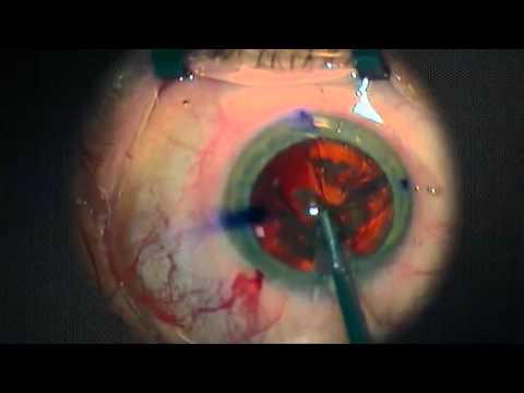 Spectacle free cataract surgery