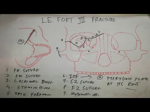 Le fort III fracture line
