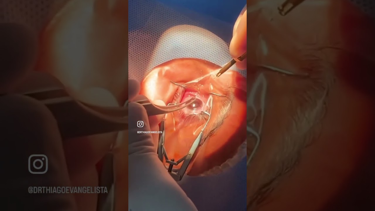 Cirurgia de Ceratocone