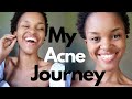 Products That Cured My Acne || Hilamaya Products Review ||Skin care || South African YouTuber