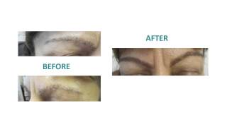 Εyebrow transplant & restoration with Advanced FUE _ Dr.Anastasios Vekris