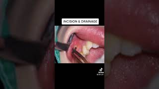 TOOTH ABSCESS (Incision &amp; drainage)