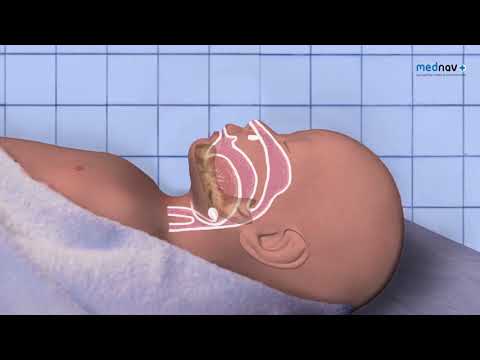 How to perform Neonatal Resuscitation, Resuscitate Newborn, NLS, Newborn Life Support 2015 guidance
