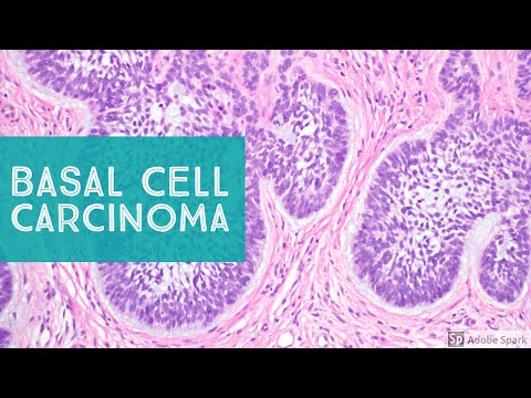 Basal Cell Carcinoma (BCC) 101 - Dermpath Basics Explained by a Dermatopathologist