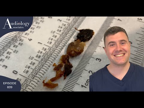 SOLID STICKY EAR WAX REMOVAL- EP839