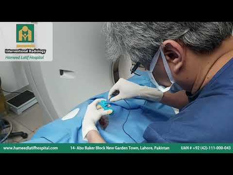 Osteoid Osteoma I Minimal Invasive treatment I IRCC Pakistan