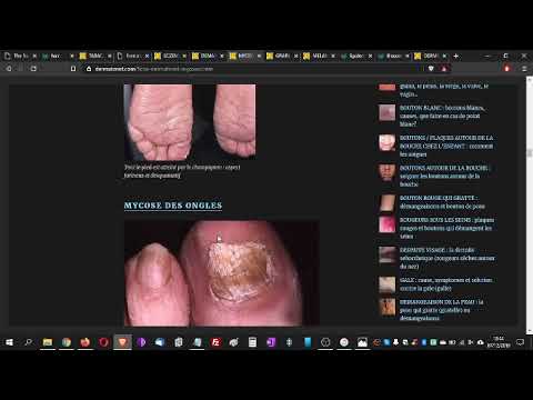 Vidéo : mycose génitale