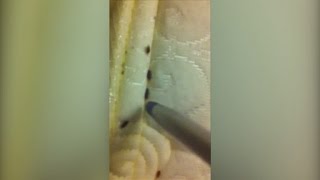 Couple Films Bedbugs Crawling on Their Sheets in Manhattan Hotel