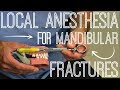 Local Anesthesia for Mandibular Fractures