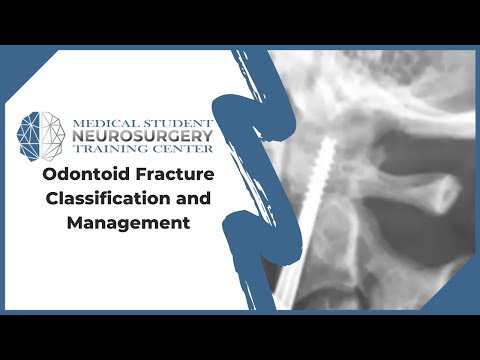 Odontoid Fracture Classification and Management