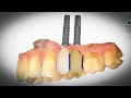 Dental Implants - AMAZING NEW 3D Technology!