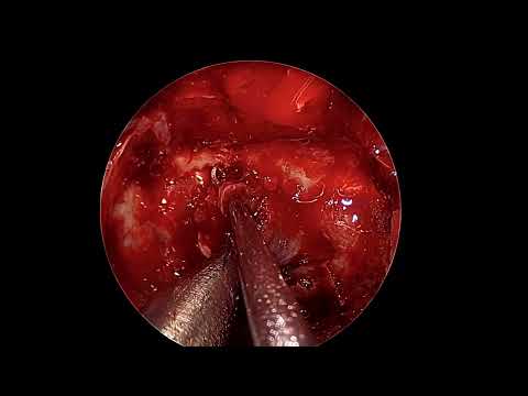PITUITARY MACROADENOMA | ENDOSCOPIC ENDONASAL RESECTION