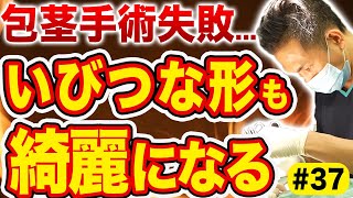 傷跡修正で綺麗なペニスに！他の病院で失敗した包茎手術の傷跡が治るまでを大公開