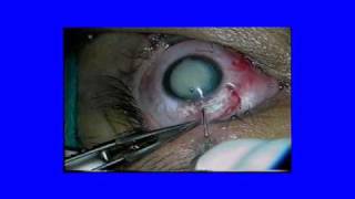 Cirugía de Catarata Editada