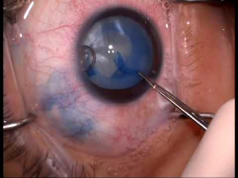 Diabetic Cataract Surgery