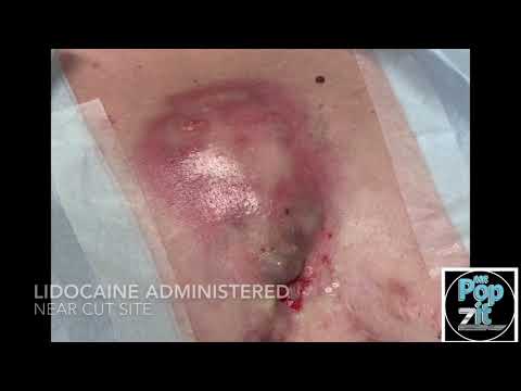 1 chest 1 cup Gigantic Hidradenitis Abscess over sternum. I+D large pocket popped and drained.