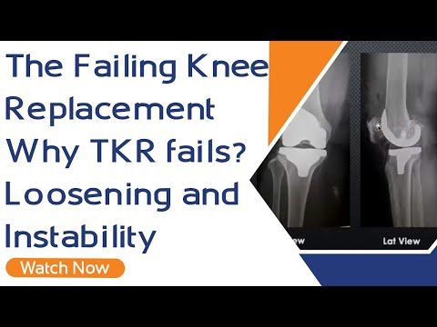 The Failing Knee Replacement