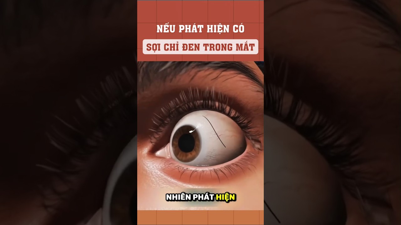 Sợi chỉ đen trong mắt