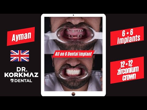 Before & After Transformations | Dr. Korkmaz Dental Clinic - Hollywood Smiles in Istanbul!