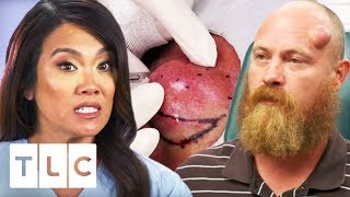 Dr. Lee Squeezes An 18 Year Old Cyst! | Dr. Pimple Popper