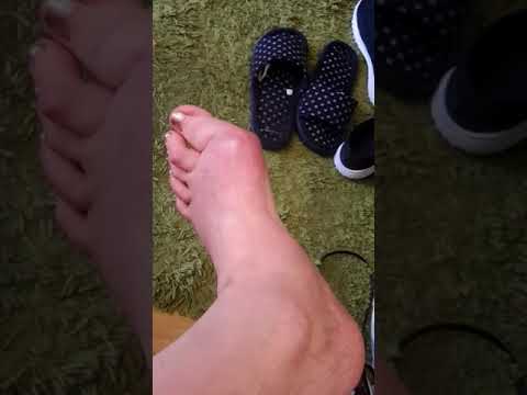 Лечение воспаления сустава первого пальца ноги (свой опыт)