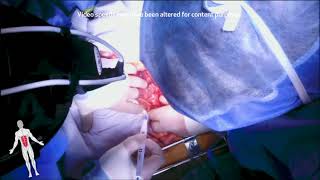 Download Lagu Aortorenal Bypass (Alan B. Lumsden, MD, M. Mujeeb Zubair MD, Luis Gomez, MD) Thumbnail