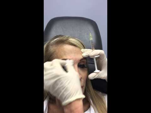 Belatero fine lines.      Facial fillers.                  Diane Walder M D