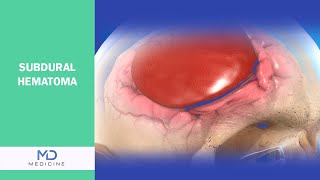 Head Injury Warning Sign: Everything You Need to Know About Subdural Hematoma  @mdmedicine.network