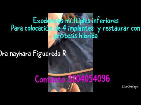 Así se fija el implante dental al hueso