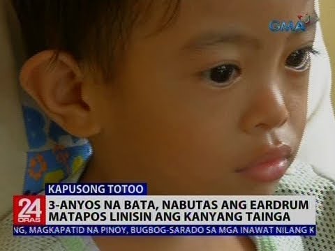 3-anyos na bata, nabutas ang eardrum matapos linisin ang kanyang tainga