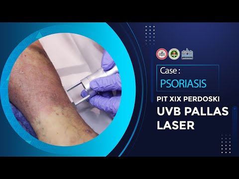 PIT XIX Perdoski Jakarta 2023 PALLAS LASER FOR PSORIASIS with dr. Antoni Miftah Sp.KK, FINSDV, FAADV