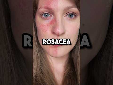 How to heal rosacea #health #rosacea #guthealth