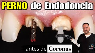 ENDOPOSTE (POSTE DE ENDODONCIA) / PERNO PARA CORONA EN PRÓTESIS DENTAL