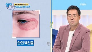 머리끝부터 발끝까지! 당신의 피부에도 곰팡이가 생길 수 있다? MBN 201208 방송