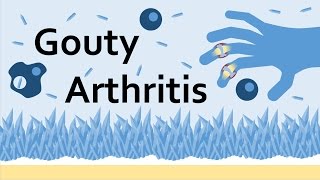 Gouty Arthritis (Gout) and Uric Acid