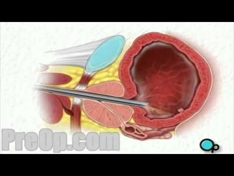 Cystoscopy Male Surgery PreOp® Medical Patient Education