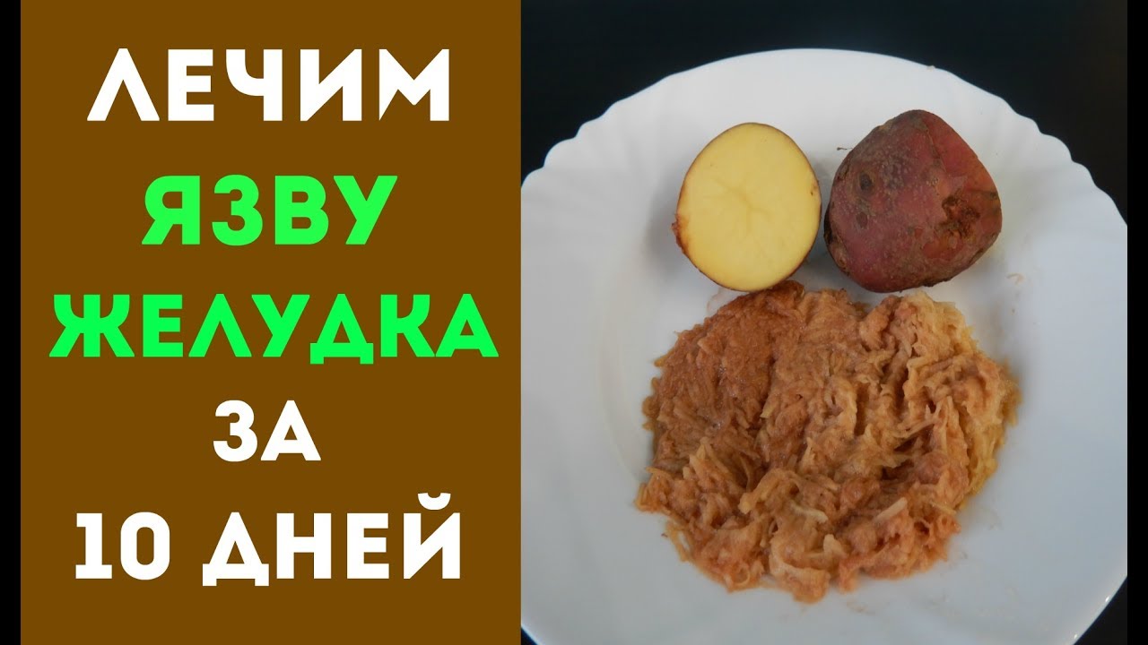 КАК ВЫЛЕЧИТЬ  ЯЗВУ ЖЕЛУДКА И ГАСТРИТ ЗА 10 ДНЕЙ КАРТОФЕЛЕМ