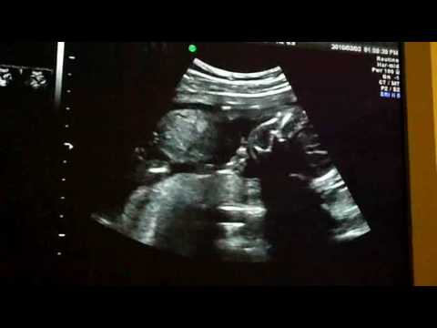 Ultraljud vecka 19+5