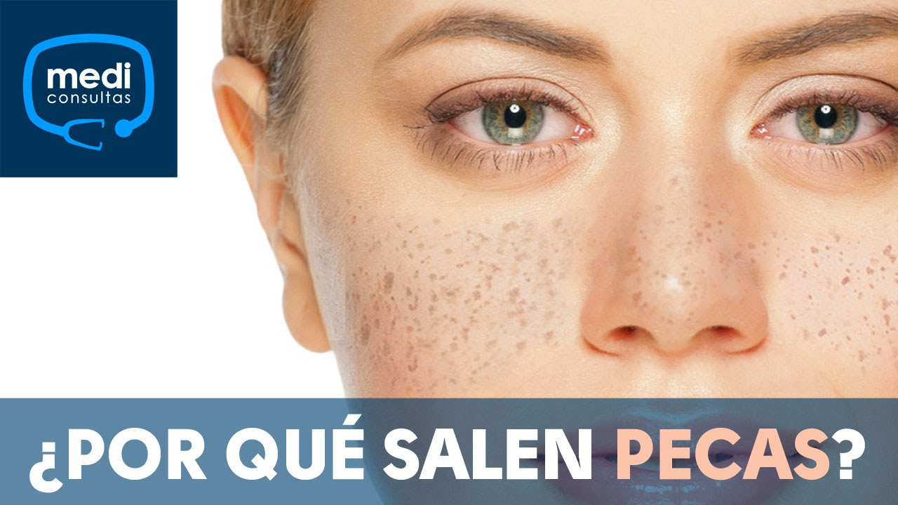 ¿Por qué salen pecas en la piel #MediConsultas