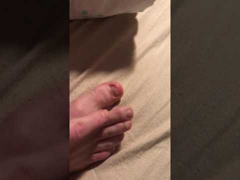 Pamahid para sa mga halamang-singaw sa pagitan ng iyong toes presyo Komposisyon ekzoderil cream